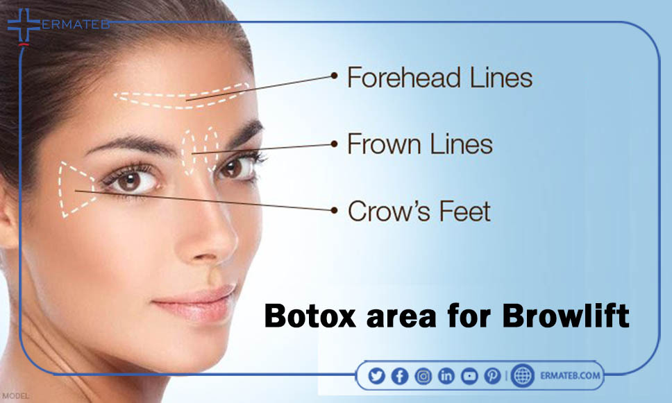 botox area for brow lift